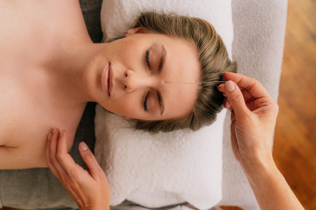 woman getting acupuncture as one of the natural remedies for pmdd